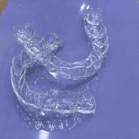 我戴保持器，但同时是篮球爱好者。